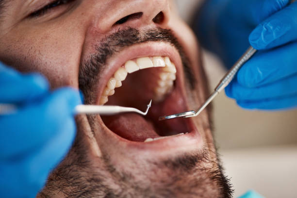 Best Knocked-Out Tooth (Avulsed Tooth) Treatment in Winnie, TX
